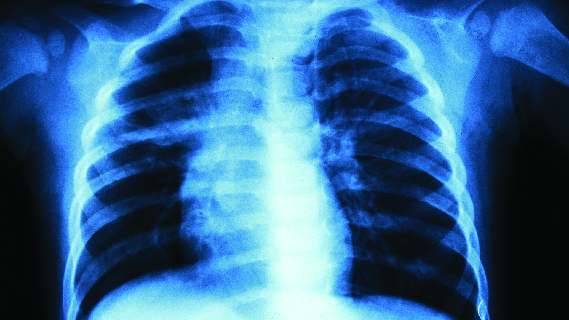 Can an xray show lung cancer